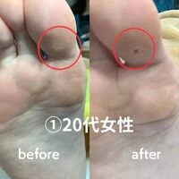 画像1480：30代女性/肥厚爪ケア