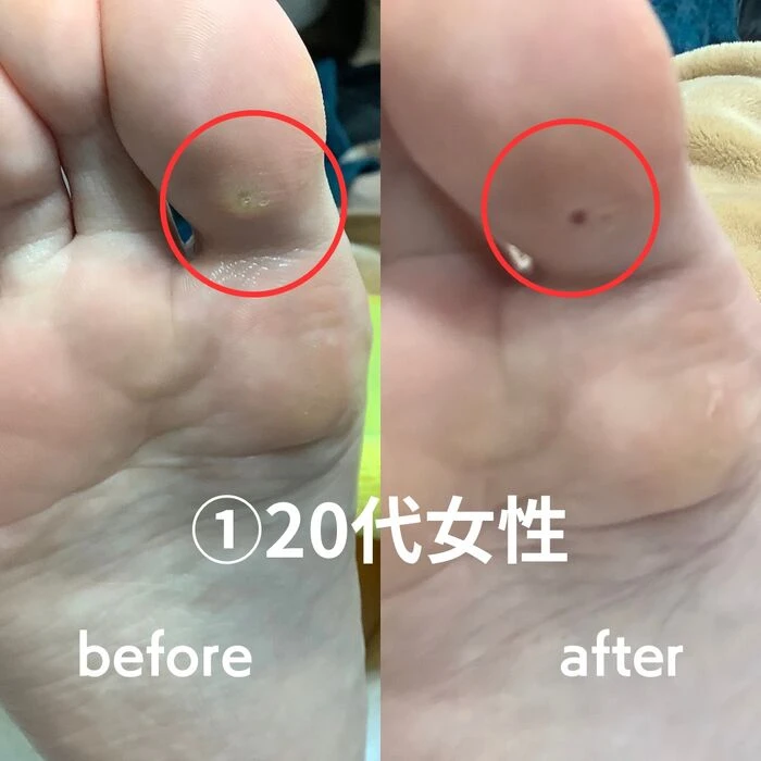 画像1480：30代女性/肥厚爪ケア