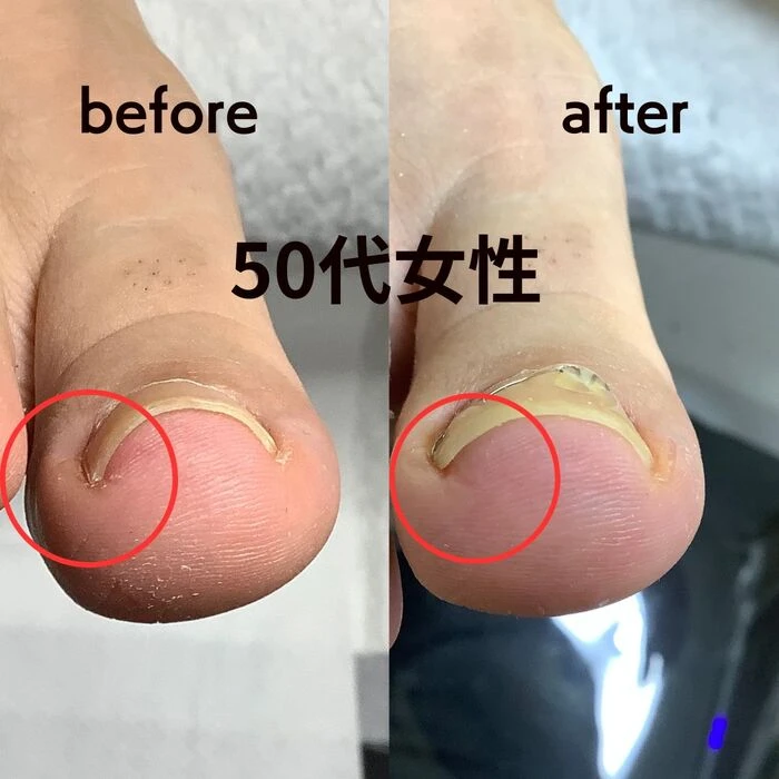 画像1489：30代女性/肥厚爪ケア