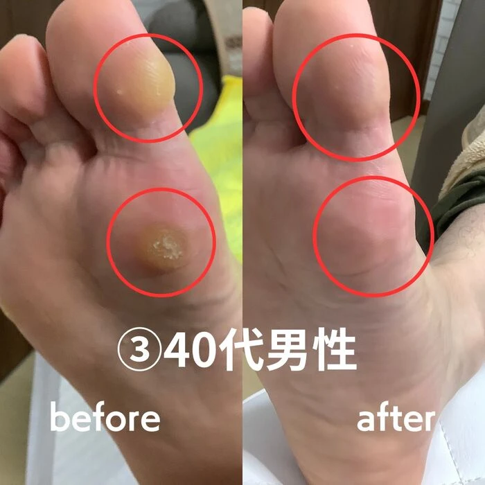 画像1492：30代女性/肥厚爪ケア