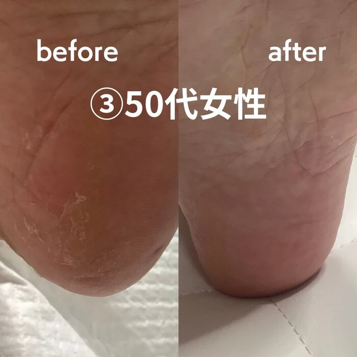 画像1500：30代女性/肥厚爪ケア