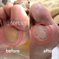 画像1503：30代女性/肥厚爪ケア