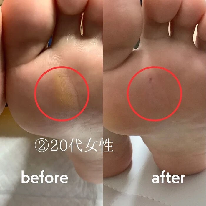 画像1512：30代女性/肥厚爪ケア