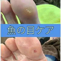 画像15620：30代女性/肥厚爪ケア