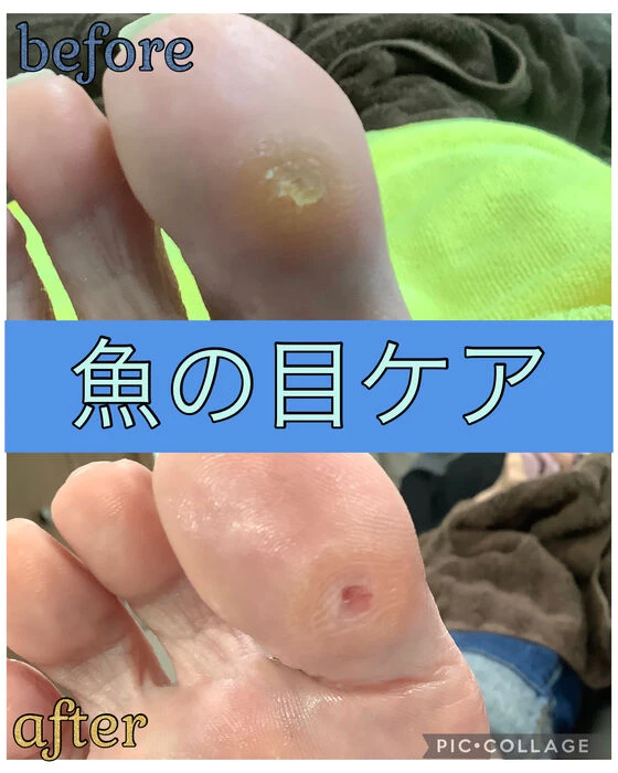 画像15620：30代女性/肥厚爪ケア