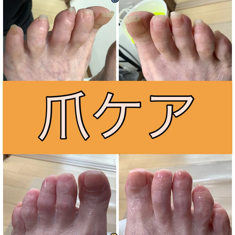 画像15622：30代女性/肥厚爪ケア