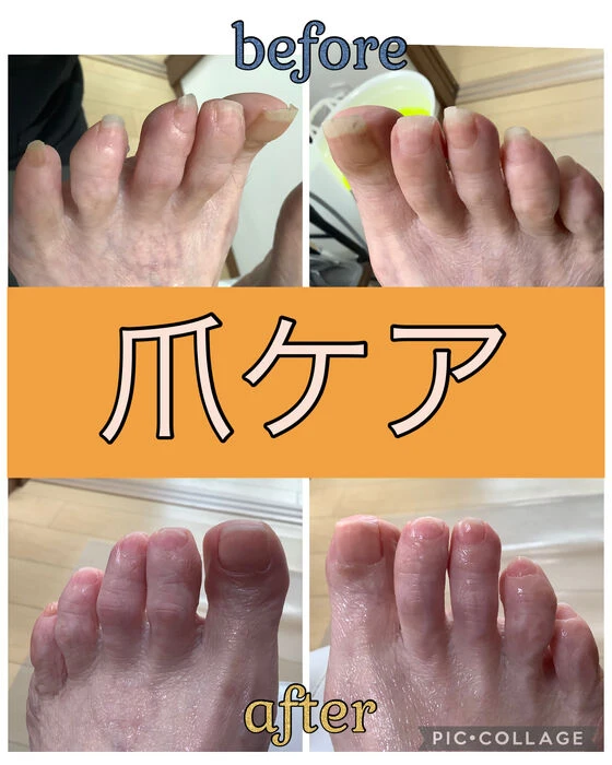 画像15622：30代女性/肥厚爪ケア