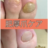 画像15624：30代女性/肥厚爪ケア