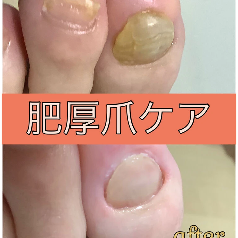 画像15624：30代女性/肥厚爪ケア
