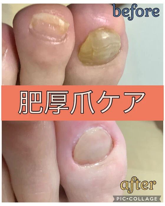 画像15624：30代女性/肥厚爪ケア