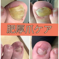 画像15626：30代女性/肥厚爪ケア