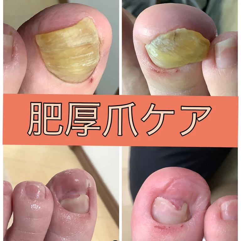 画像15626：30代女性/肥厚爪ケア