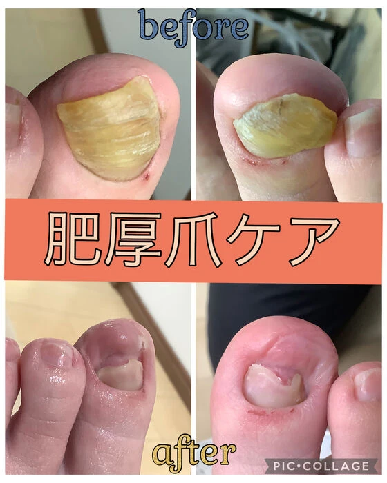 画像15626：30代女性/肥厚爪ケア
