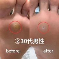 画像1599：30代女性/肥厚爪ケア