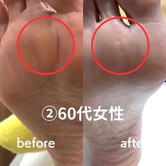 画像1602：60代女性/タコ・魚の目ケア