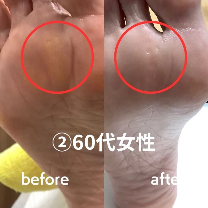 画像1602：30代女性/肥厚爪ケア