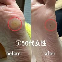 画像1741：30代女性/肥厚爪ケア