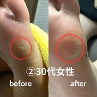 画像1752：30代女性/肥厚爪ケア