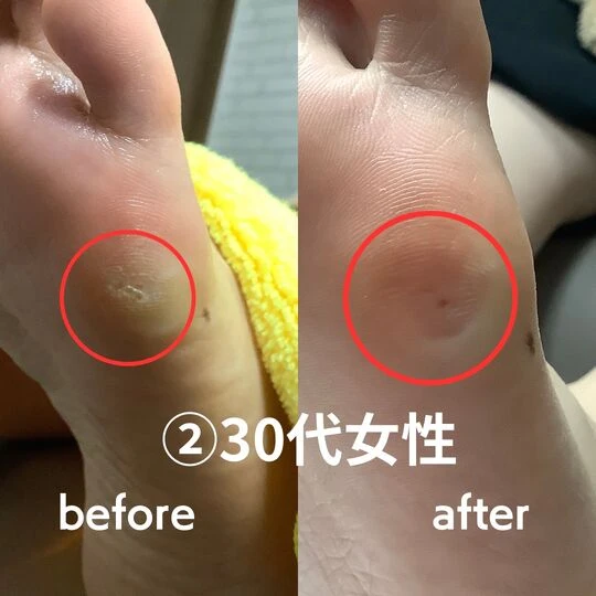 画像1752：30代女性/タコ・魚の目、角質ケア