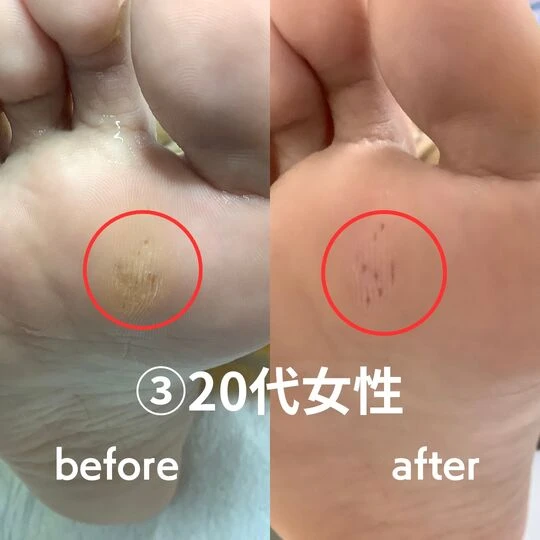 画像1755：20代女性/タコ・魚の目ケア