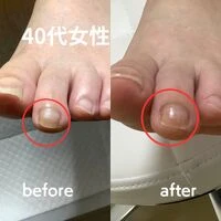 画像1975：30代女性/肥厚爪ケア