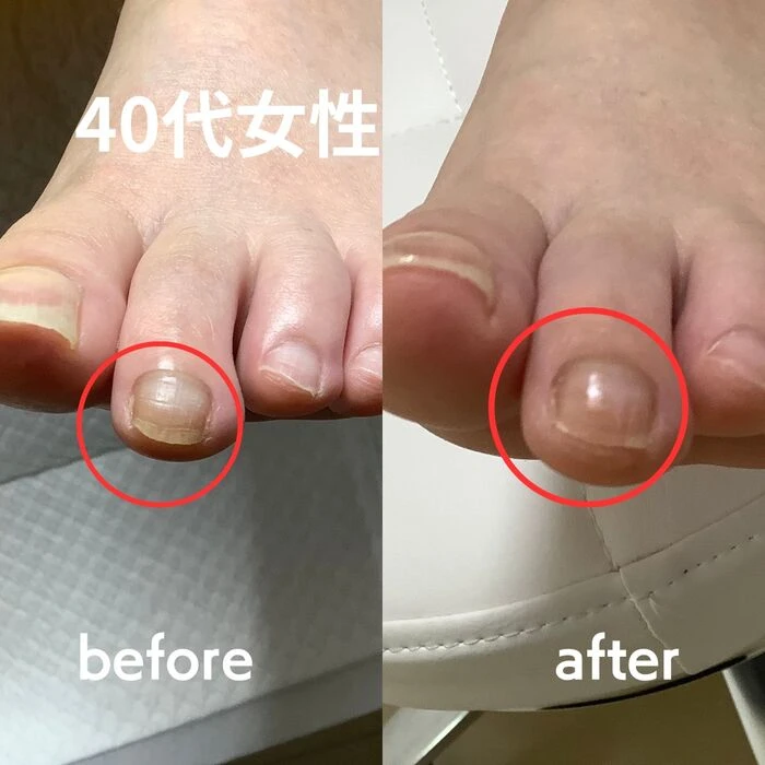 画像1975：30代女性/肥厚爪ケア