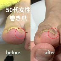 画像2229：30代女性/肥厚爪ケア