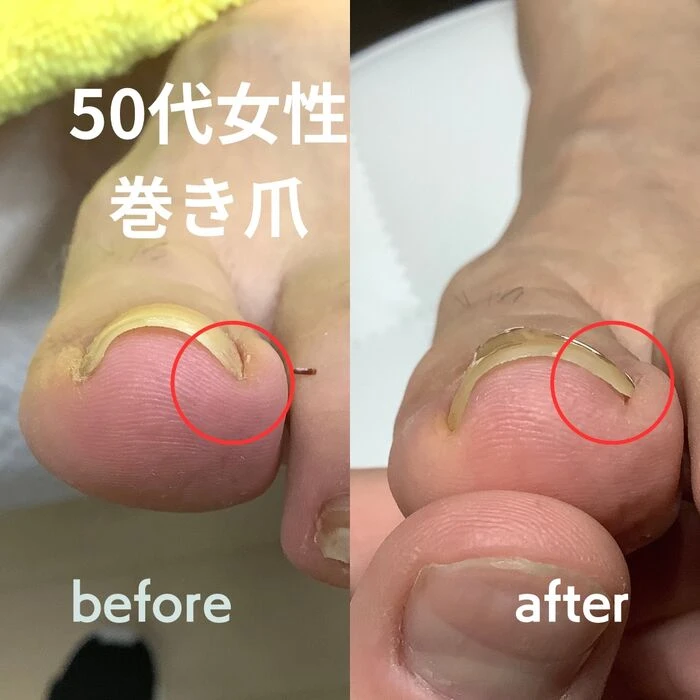 画像2229：30代女性/肥厚爪ケア