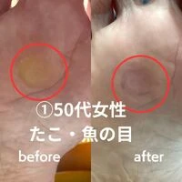 画像2241：30代女性/肥厚爪ケア
