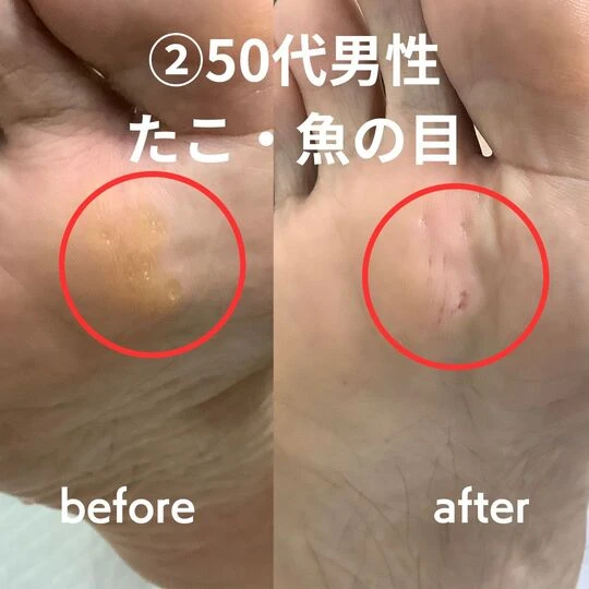 画像2244：50代男性/たこ・魚の目ケア