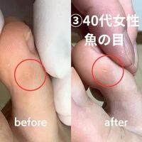 画像2246：30代女性/肥厚爪ケア