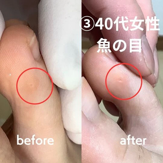 画像2246：40代女性/魚の目ケア