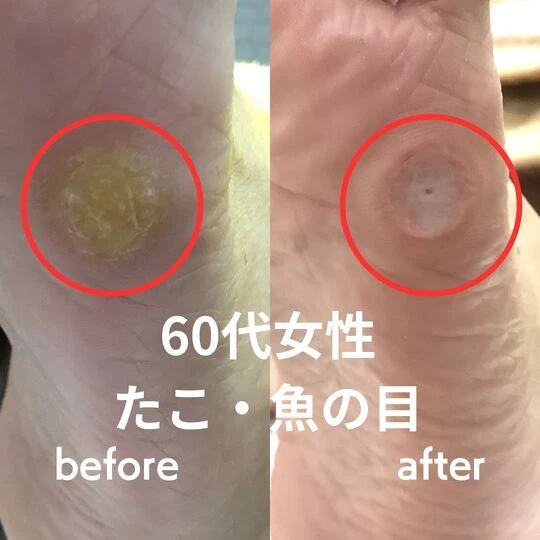 画像2249： 60代女性/たこ・魚の目ケア