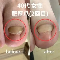 画像3180：30代女性/肥厚爪ケア