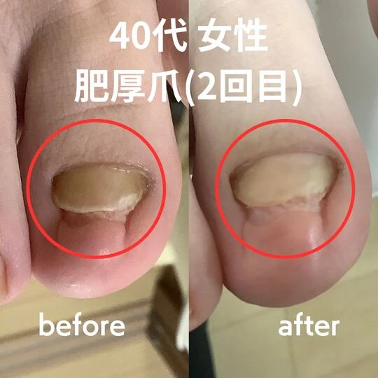 画像3180：40台女性/肥厚爪ケア(2回目)