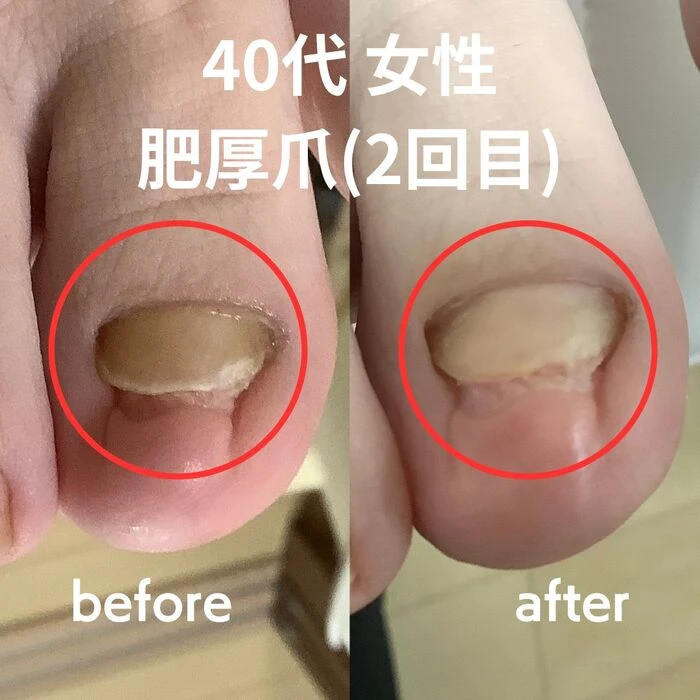 画像3180：30代女性/肥厚爪ケア