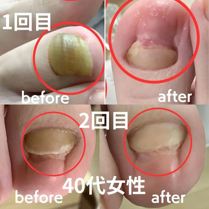 画像3181：30代女性/肥厚爪ケア