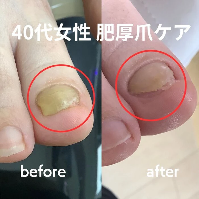 画像3184：30代女性/肥厚爪ケア