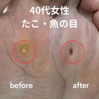 画像3187：30代女性/肥厚爪ケア
