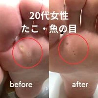 画像3190：30代女性/肥厚爪ケア