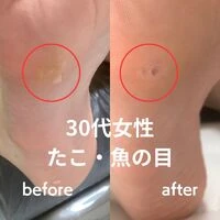 画像3193：30代女性/肥厚爪ケア