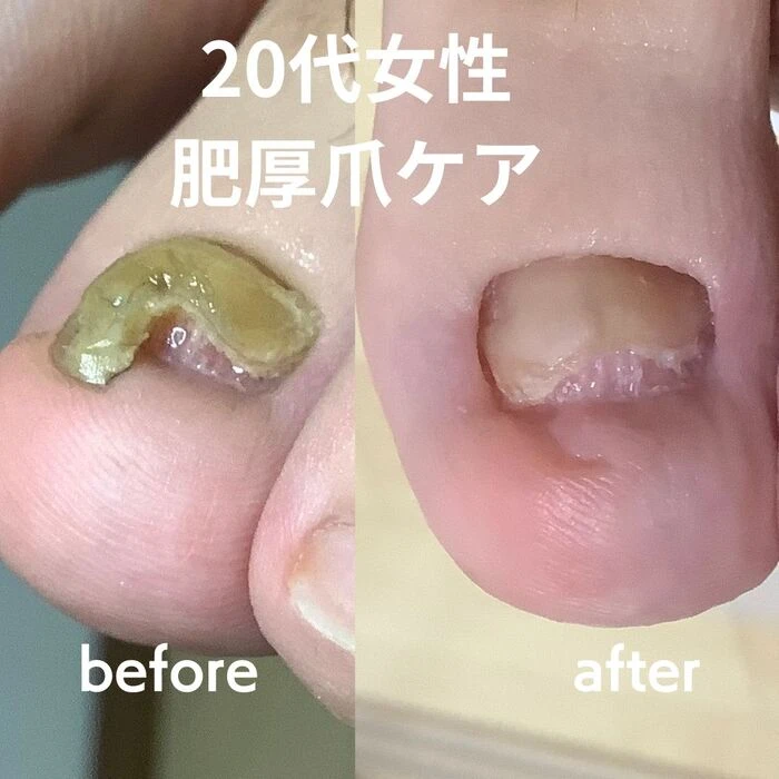 画像3215：30代女性/肥厚爪ケア