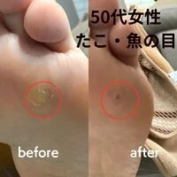 画像3218：30代女性/肥厚爪ケア