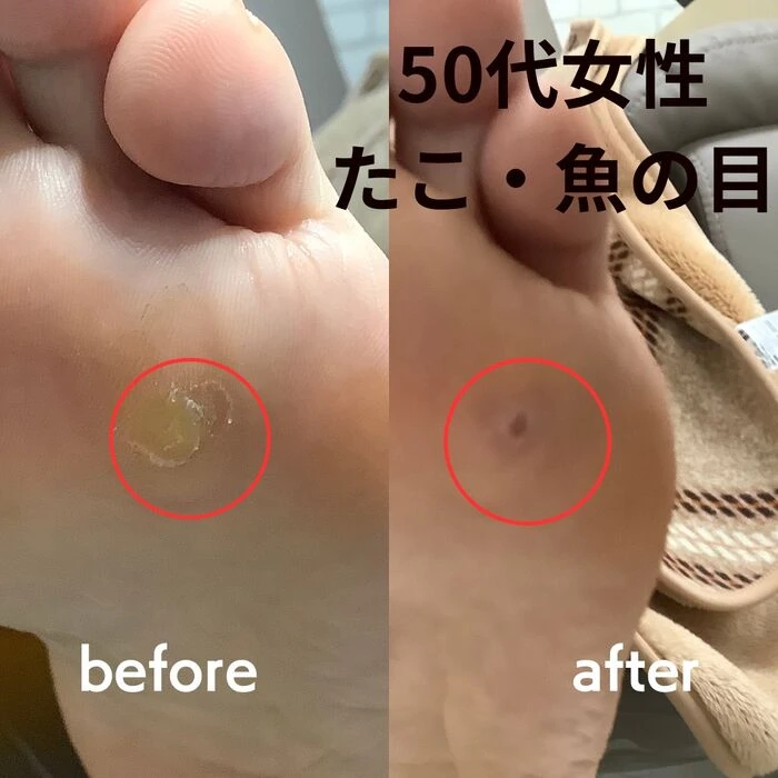 画像3218：30代女性/肥厚爪ケア