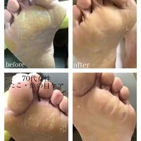 画像3391：30代女性/肥厚爪ケア