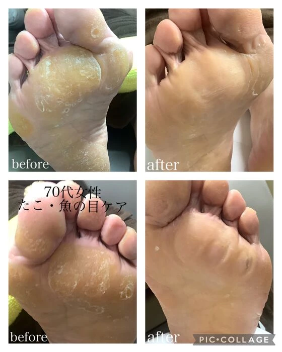画像3391：30代女性/肥厚爪ケア