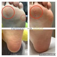 画像3924：30代女性/肥厚爪ケア