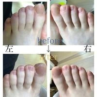 画像3927：30代女性/肥厚爪ケア