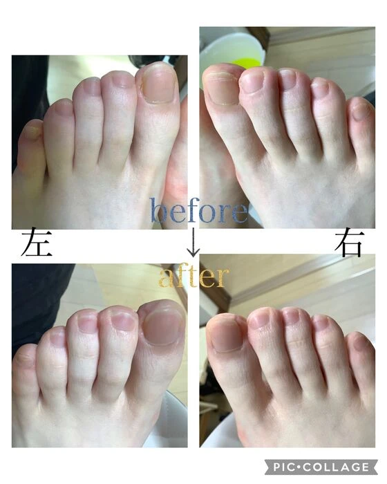 画像3927：30代女性/肥厚爪ケア