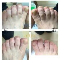 画像3930：30代女性/肥厚爪ケア